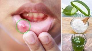 How to Get Rid of a Canker Sore Fast