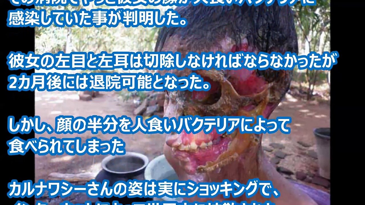 【超閲覧注意】顔面を食い尽くされた人々！ヤバすぎる…、 人喰いバクテリアの恐怖！