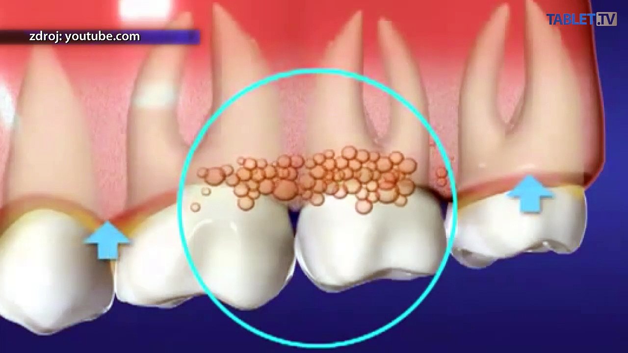 Nenechajte sa pripraviť o zuby: parodontitída (paradentóza) sa dá liečiť