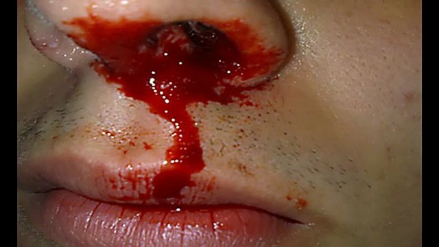 НОСОВОЕ КРОВОТЕЧЕНИЕ, как остановить кровь, кровь из носа причины, Советы от Светы