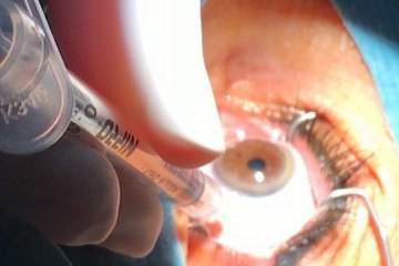 Inyecciones intravítreas para sanar los ojos