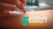 5 Alergias raras y terribles