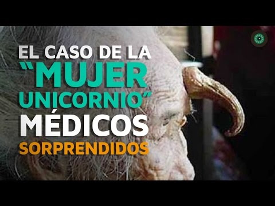 El caso de la "mujer unicornio". Médicos sorprendidos