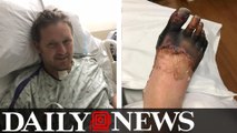 Michigan Man Will Have Hands And Feet Amputated After Strep Throat