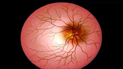 Anterior Ischemic Optic Neuropathy (AION)
