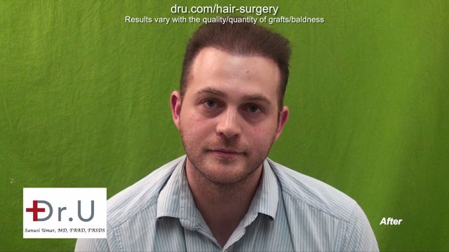 Dr Umar Did Not Restore My Hair, He Restored My Life! - DrUGraft Revolution Hair Transplant Repair
