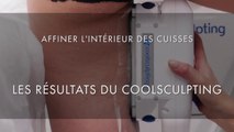 Les résultats du COOLSCULPTING sur l'intérieur des cuisses - Centre Marceau Paris
