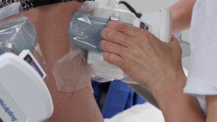 CRYOLIPOLYSE par COOLSCULPTING - Etape par étape - Centre Marceau Paris