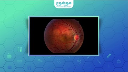 #موضوع: ما هو اعتلال الشبكية؟
