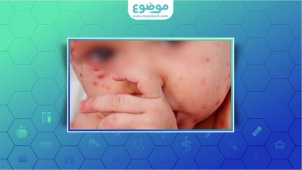 #موضوع: جدري الماء عند الأطفال