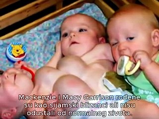Three conjoint Babies born in USA
