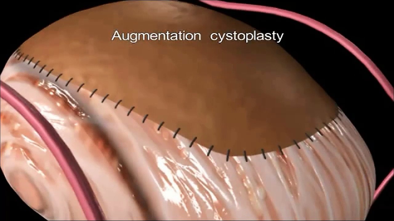 Augmentation cystoplasty