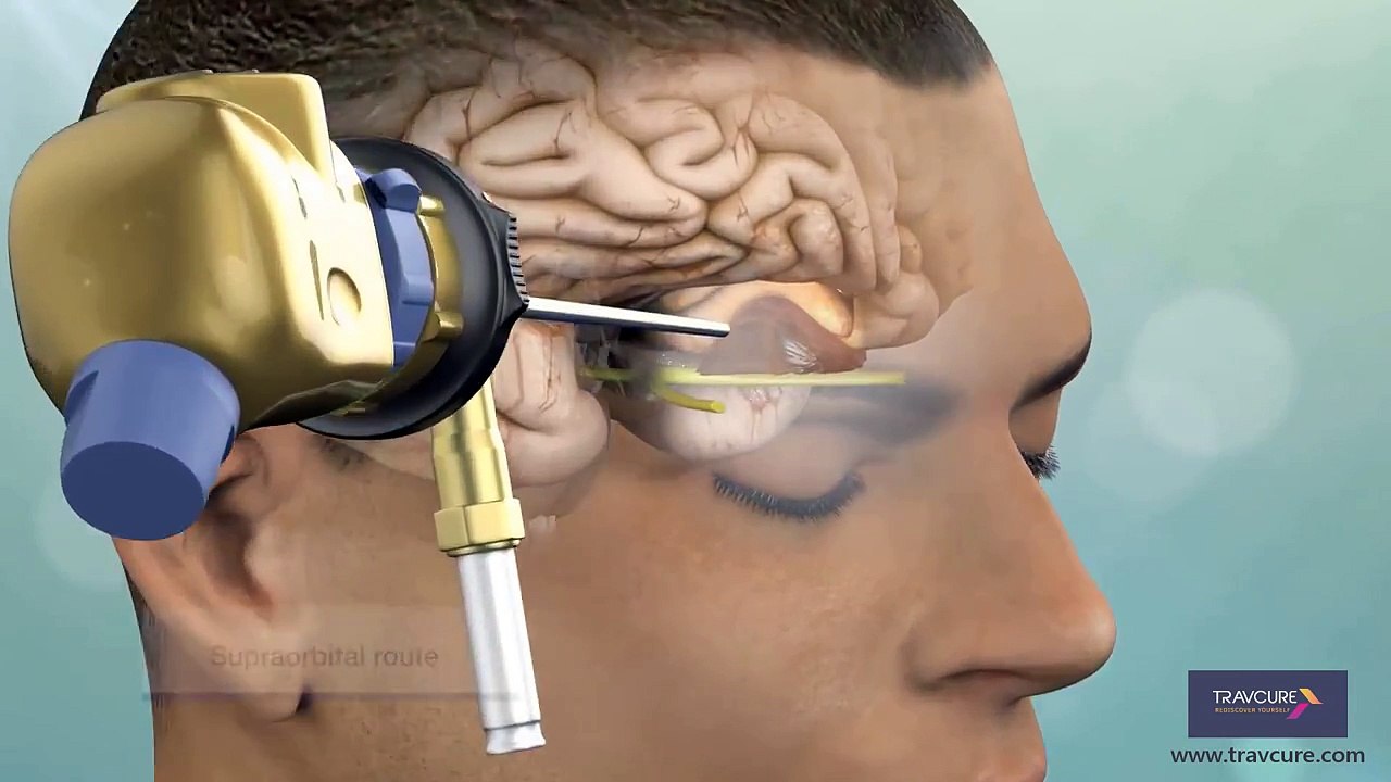 Keyhole Surgery: Minimally Invasive Way for Brain Tumor Removal | SurgeryLog