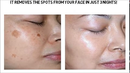 It Removes The Spots From Your Face In Just 3 Nights