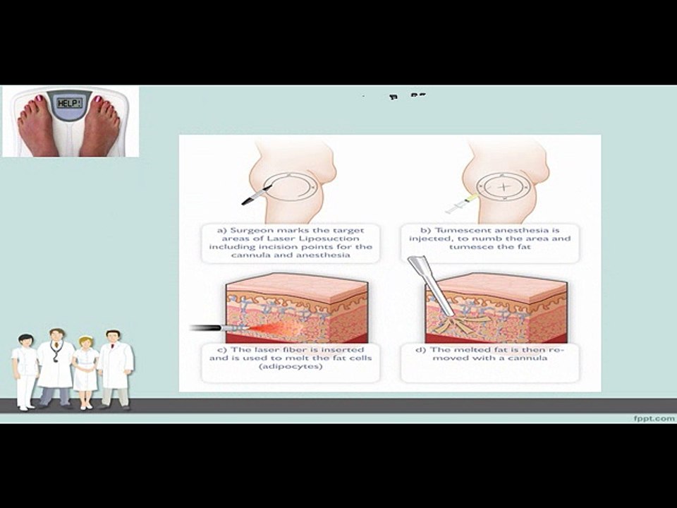 What is Liposuction Weight Loss Treatment?