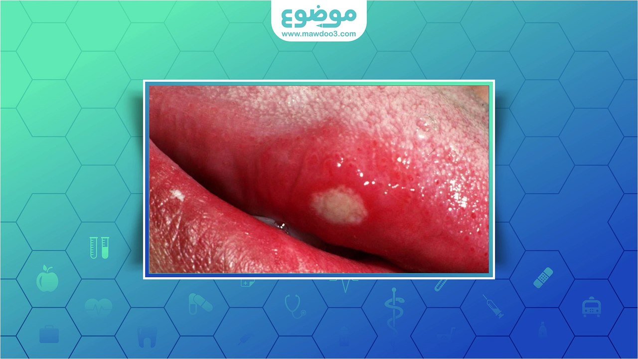 #موضوع: أنواع تقرحات اللسان وعلاجها