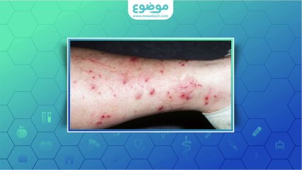 #موضوع: ما هي الأكزيما العصبية؟