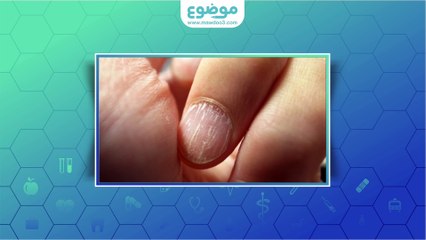 #موضوع: ما هي أسباب تكسر الأظافر؟