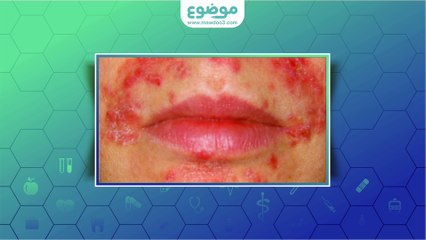 #موضوع: ما هو مرض #الجرب أو الحكاك؟