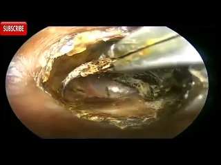 Ear Wax Removal BEST COMPILATION