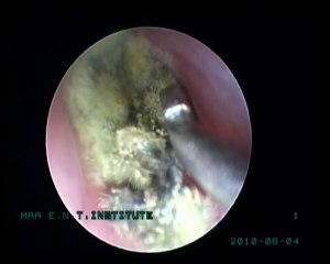 Ear Wax Removal(Removing Fungal Debris)
