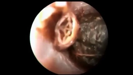 impacted ear wax and cockroach
