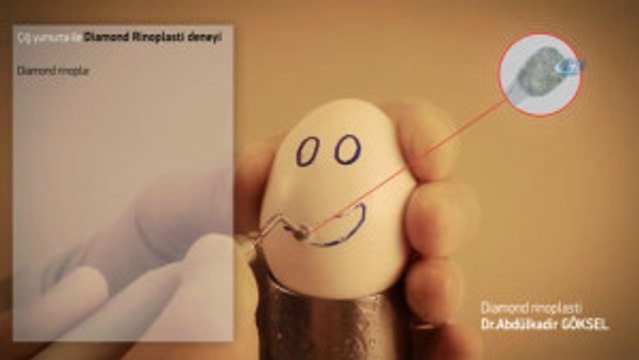 Alman ve Ruslar Burun Estetiği İçin Türkiye'ye Akın Ediyor