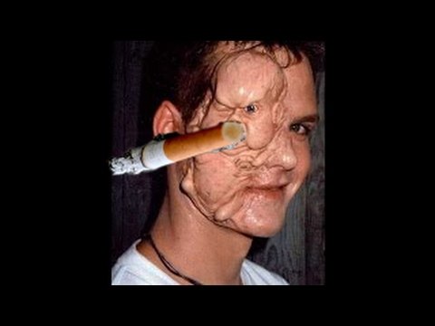 Chuyện lạ có thật: Vết loét trên mặt biết ăn cơm và nói chuyện như người