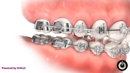 Forsus Appliance[via torchbrowser.com]