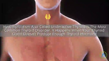 Hypothyroidism: Causes, Symptoms, and Treatments