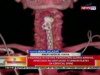 BT: Paghinga ni Rep. Gloria Arroyo, apektado ng displaced titanium plates sa cervical spine
