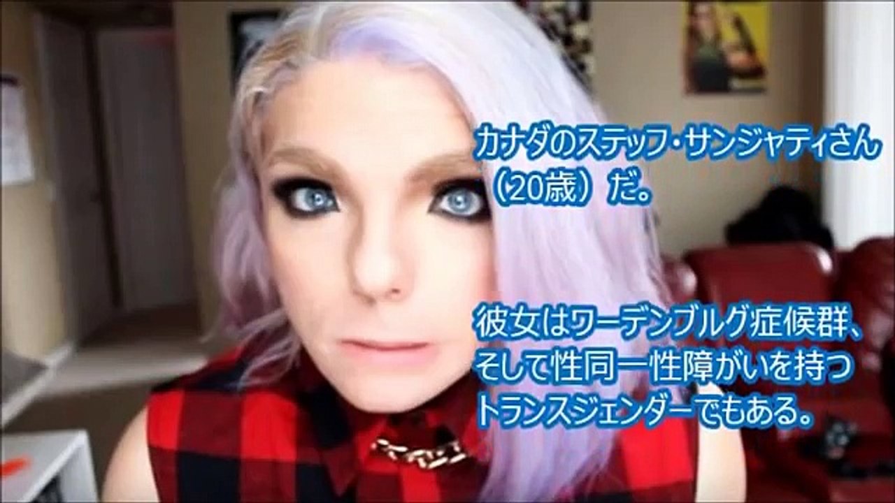 閲覧注意 妖精の顔 で生まれる奇病 世界が震えた ワールデンブルグ症候群 嘘のような本当の驚くべき奇病がヤバすぎる Video Dailymotion