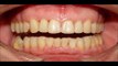 (HDVidz.in)_Orthodontic-Treatment-of-Deep-Overbite--Increased-Overjet---Mou
