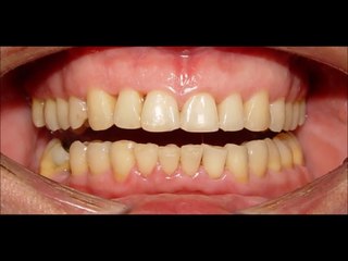 (HDVidz.in)_Orthodontic-Treatment-of-Deep-Overbite--Increased-Overjet---Mou