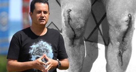 Acun Ilıcalı Dizleri Parçalanan Yarışmacının Fotoğrafını Paylaştı