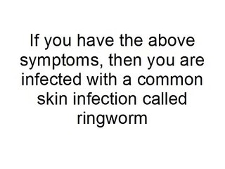 Top 3 Ringworm Treatments