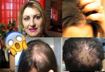 COMO ACABAR COM COÇEIRA, CASPA, QUEDA DE CABELO E FERIDINHAS NA CABEÇA RECEITA CASEIRA
