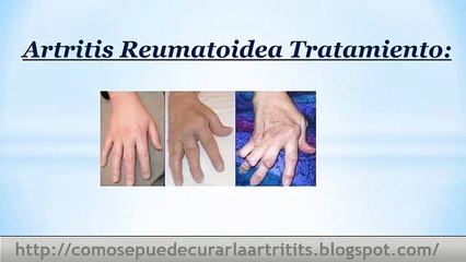 Tratamiento Definitivo Artritis Reumatoidea
