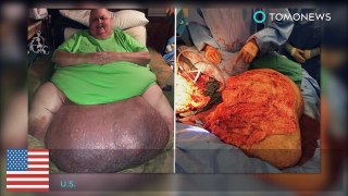Homem tem tumor de 45 quilos removido da barriga.