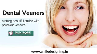 Dental Veeners In Kozhikode - Dental Porcelain Veneers Kerala