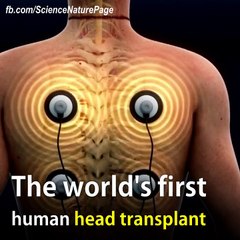 The World’s First Human Head Transplant Is Scheduled For December 2017