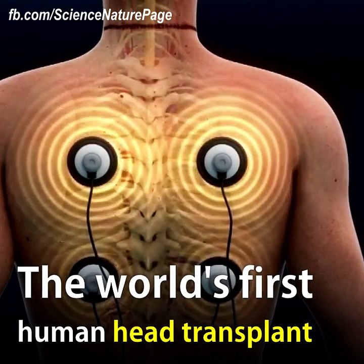 The World’s First Human Head Transplant Is Scheduled For December 2017