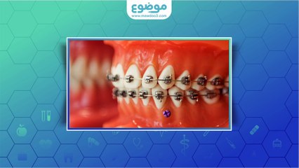 #موضوع: تقويم الأسنان