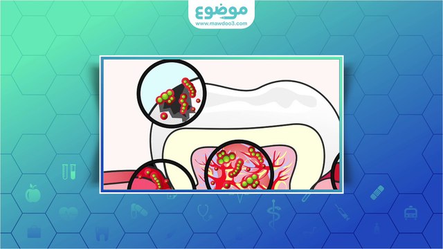 #موضوع: علاج التهاب عصب الاسنان