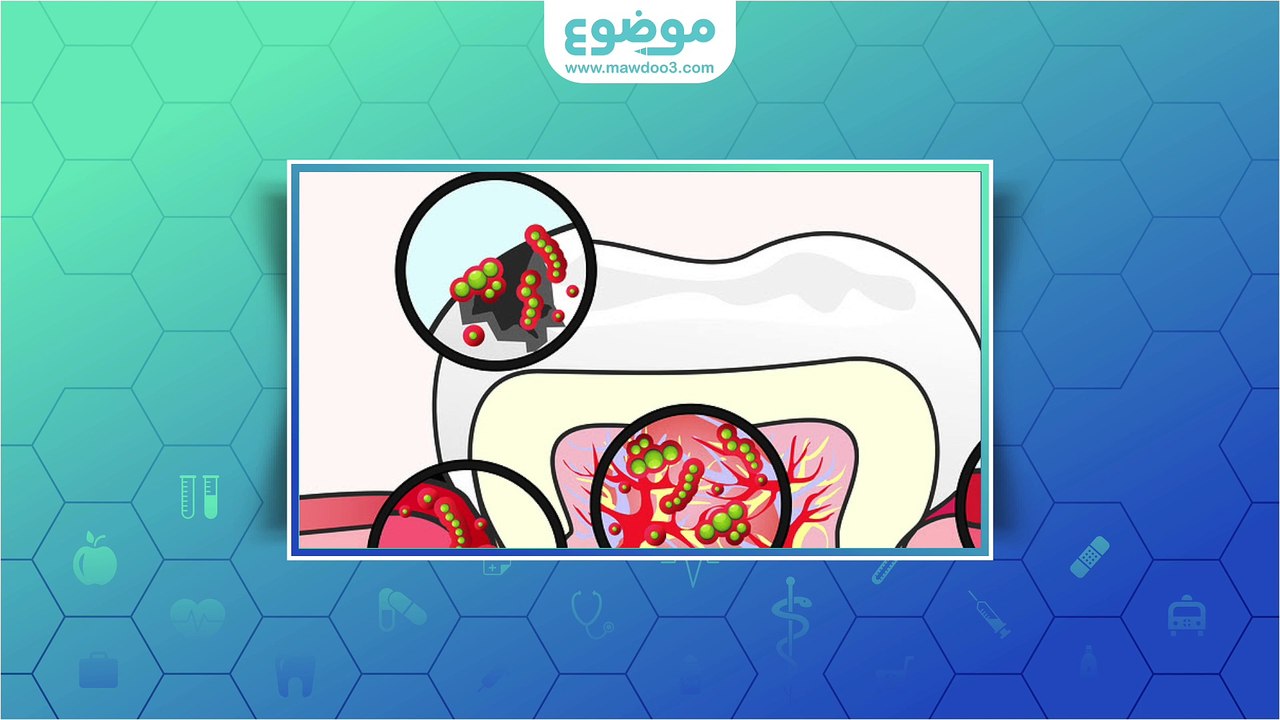 #موضوع: علاج التهاب عصب الاسنان