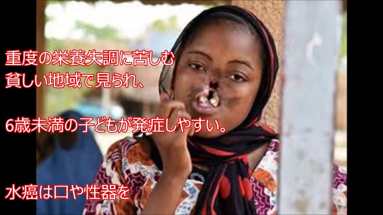 閲覧注意 世界に実在する恐ろしすぎる奇病１０選 Video Dailymotion