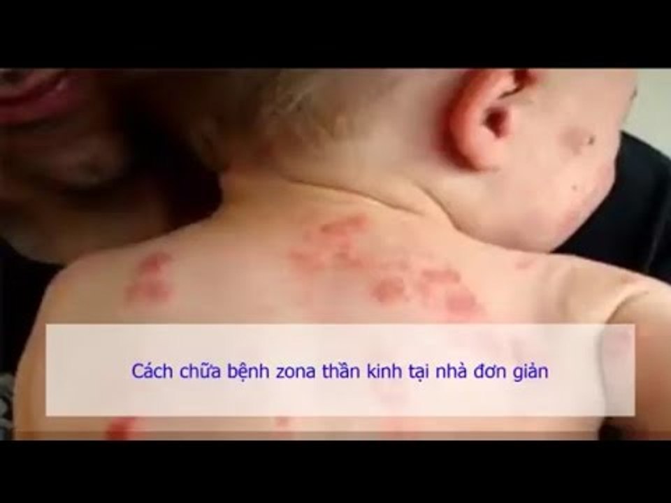Cách chữa bệnh zona thần kinh tại nhà đơn giản