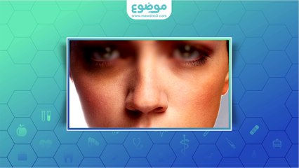 Download Video: #موضوع: ما هي أسباب السواد تحت العين