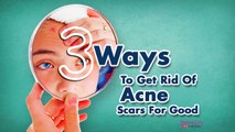 3 Ways to Get Rid of Acne Scars for Good http://BestDramaTv.Net