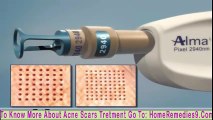 Acne Scars Treatment -  Pixel Laser Skin Resurfacing Treatment For Acne Scar http://BestDramaTv.Net